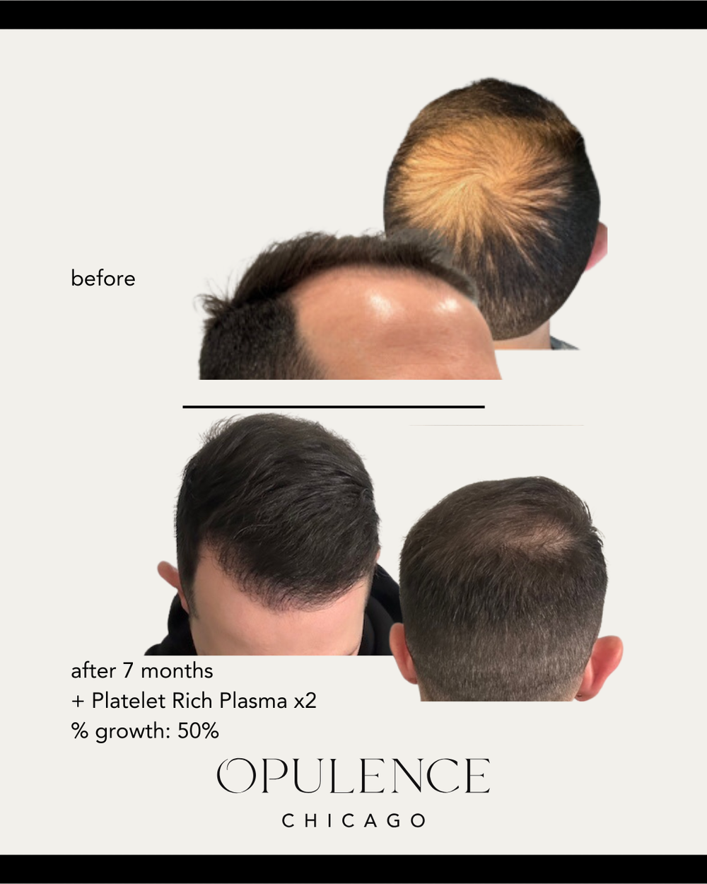 FUE hair restoration to crown — 7 months