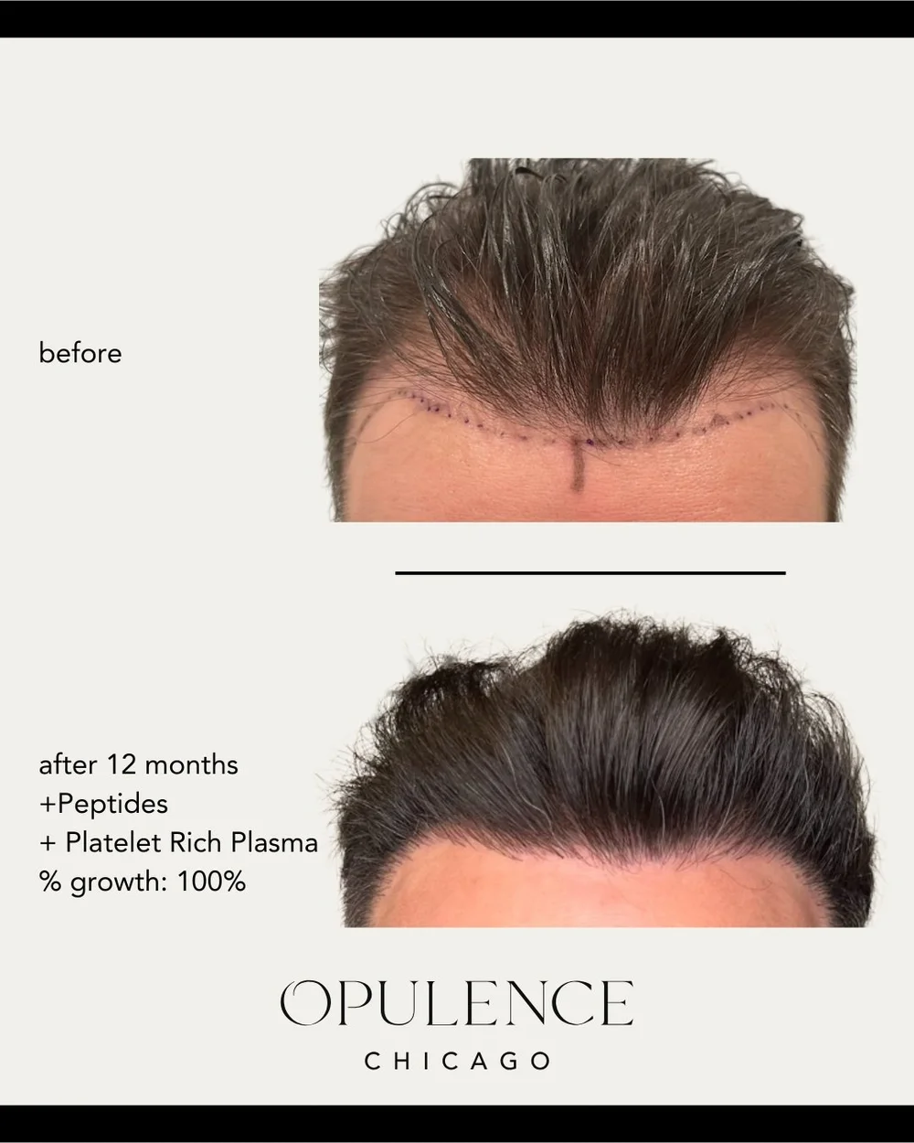 PRP and FUE hair restoration combination
